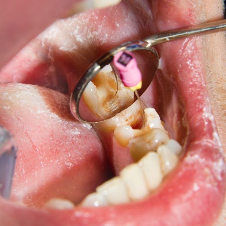 Root-Canal-treatment-2