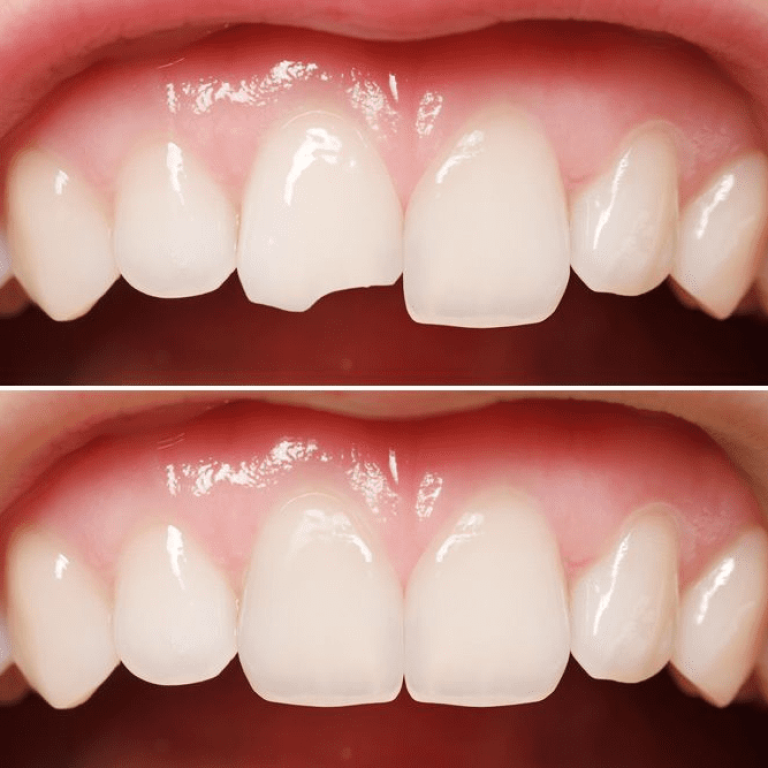 Tooth Coloured Fillings 1