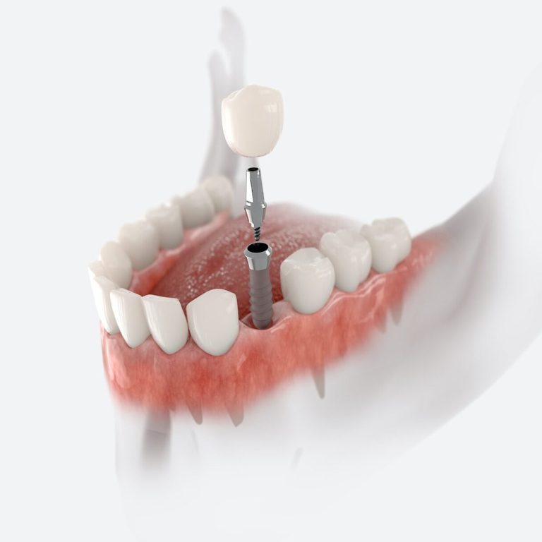 dental implant